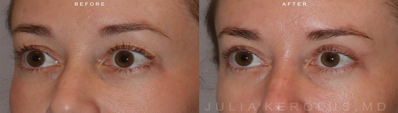 Browlift/Blepharoplasty Before & After Image