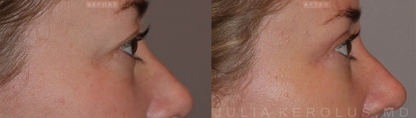 Browlift/Blepharoplasty Before & After Image