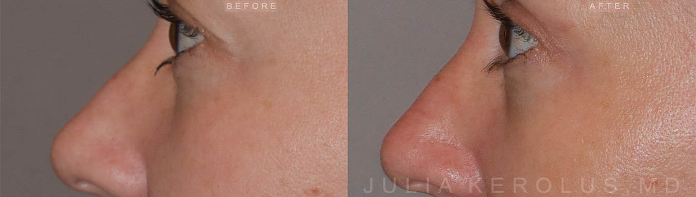 Browlift/Blepharoplasty Before & After Image