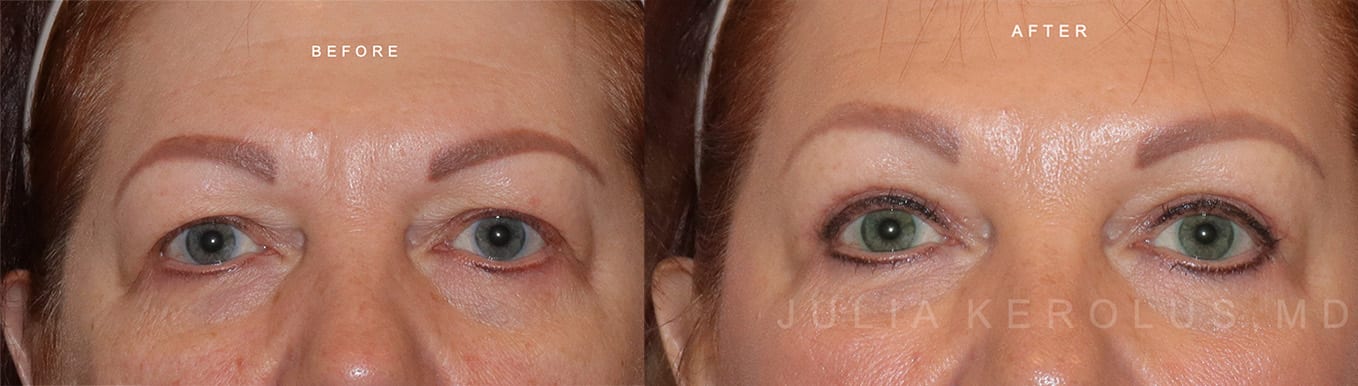 Browlift/Blepharoplasty Before & After Image