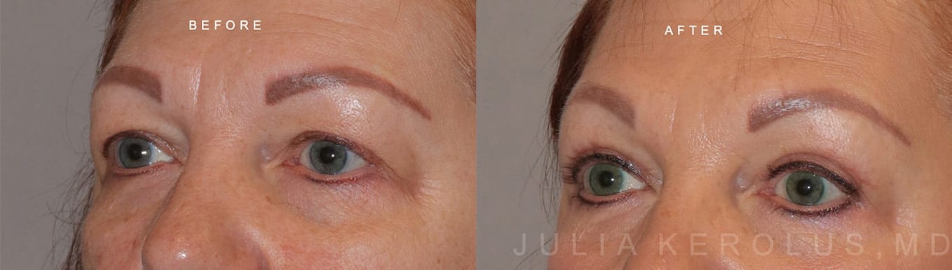 Browlift/Blepharoplasty Before & After Image