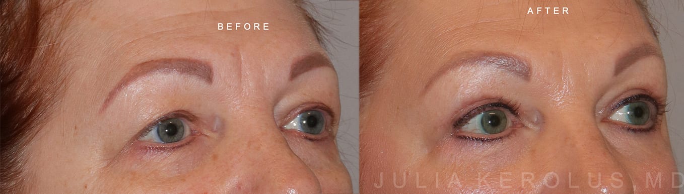 Browlift/Blepharoplasty Before & After Image