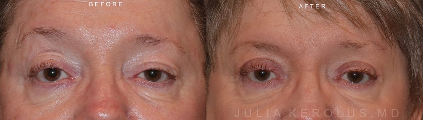 Browlift/Blepharoplasty Before & After Image