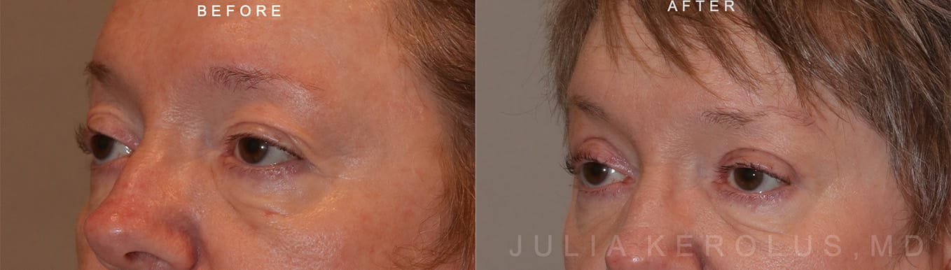 Browlift/Blepharoplasty Before & After Image