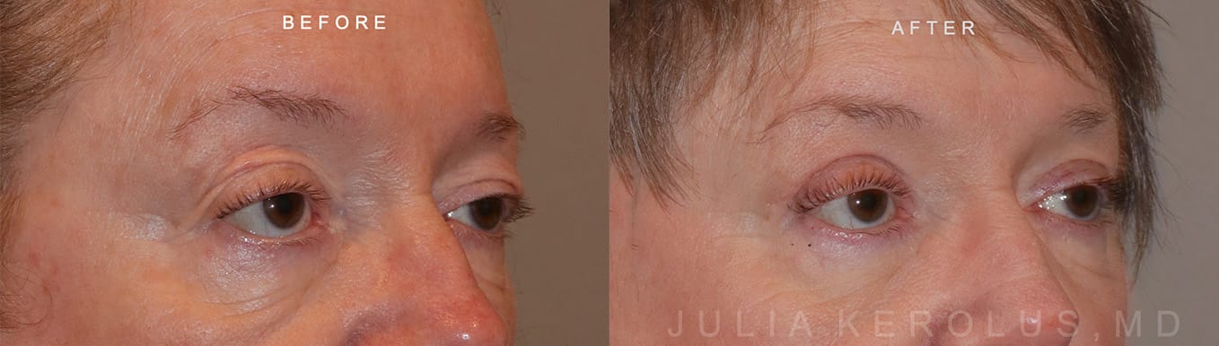 Browlift/Blepharoplasty Before & After Image