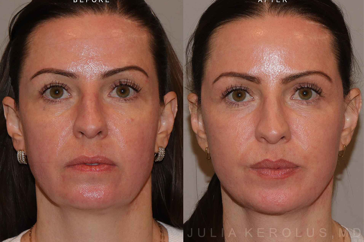 Facelift Before & After Image