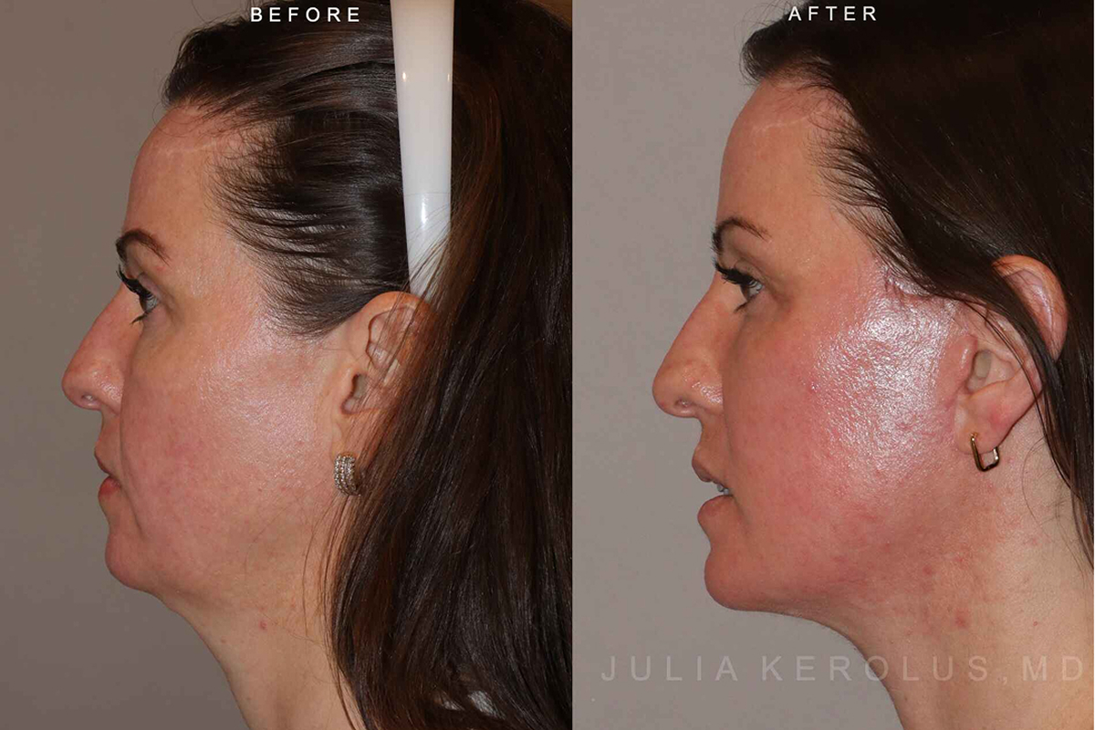 Facelift Before & After Image