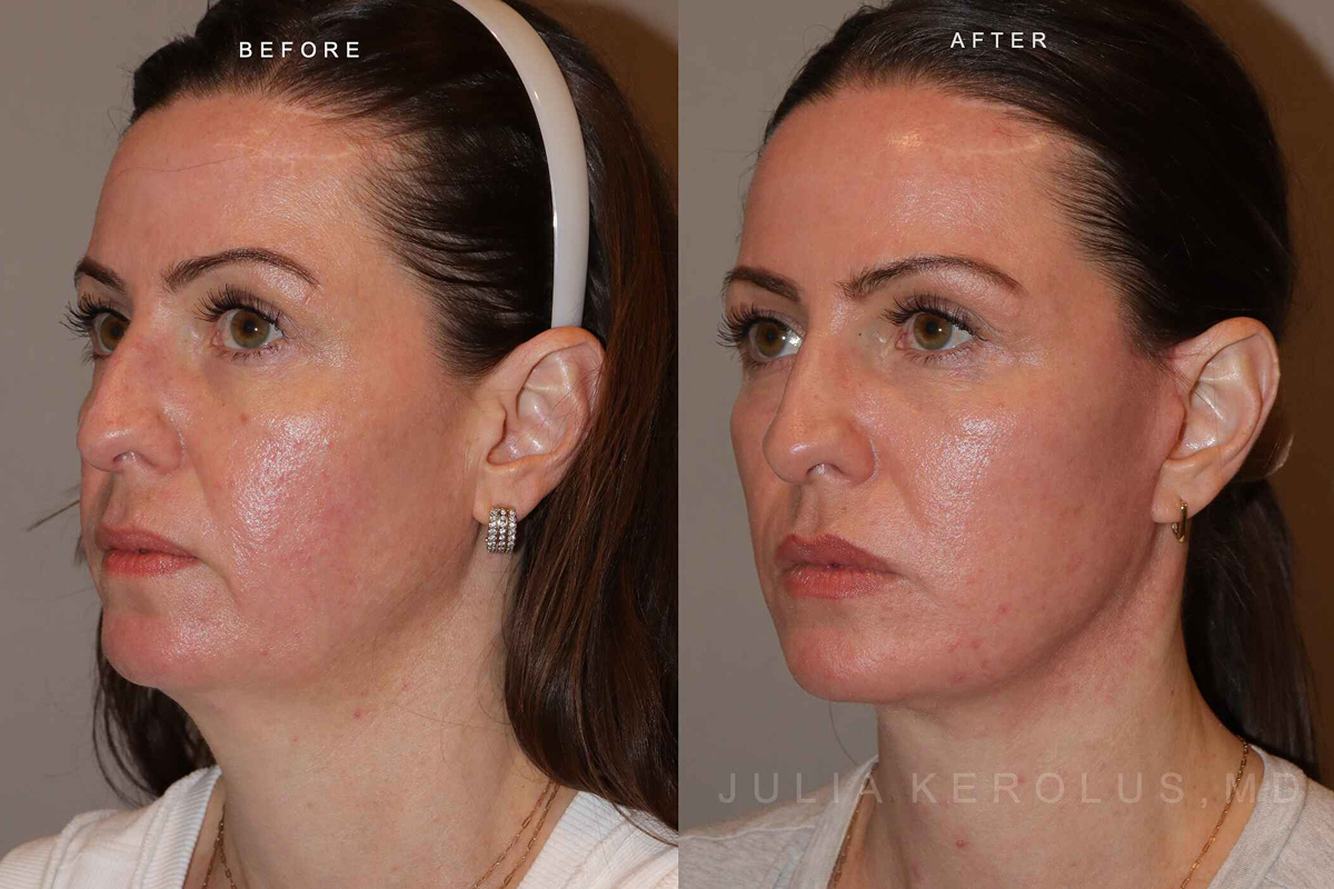 Facelift Before & After Image