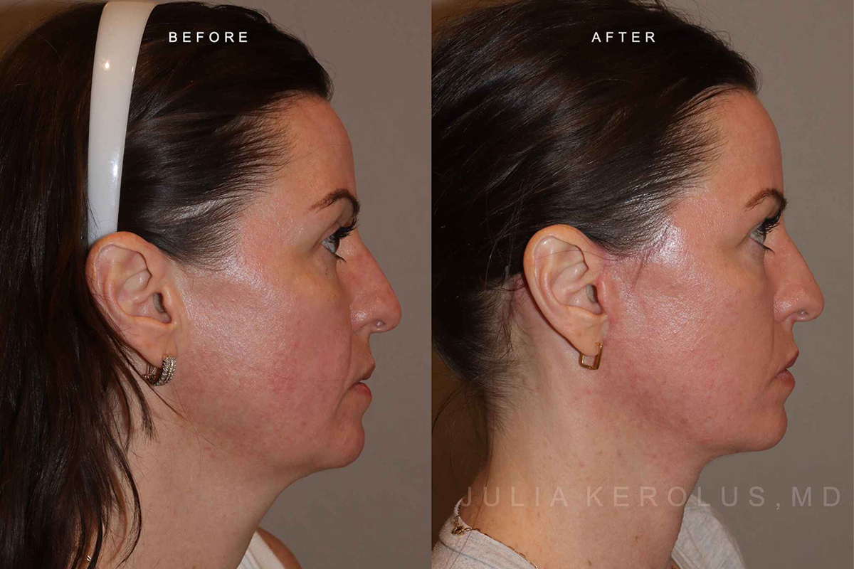 Facelift Before & After Image