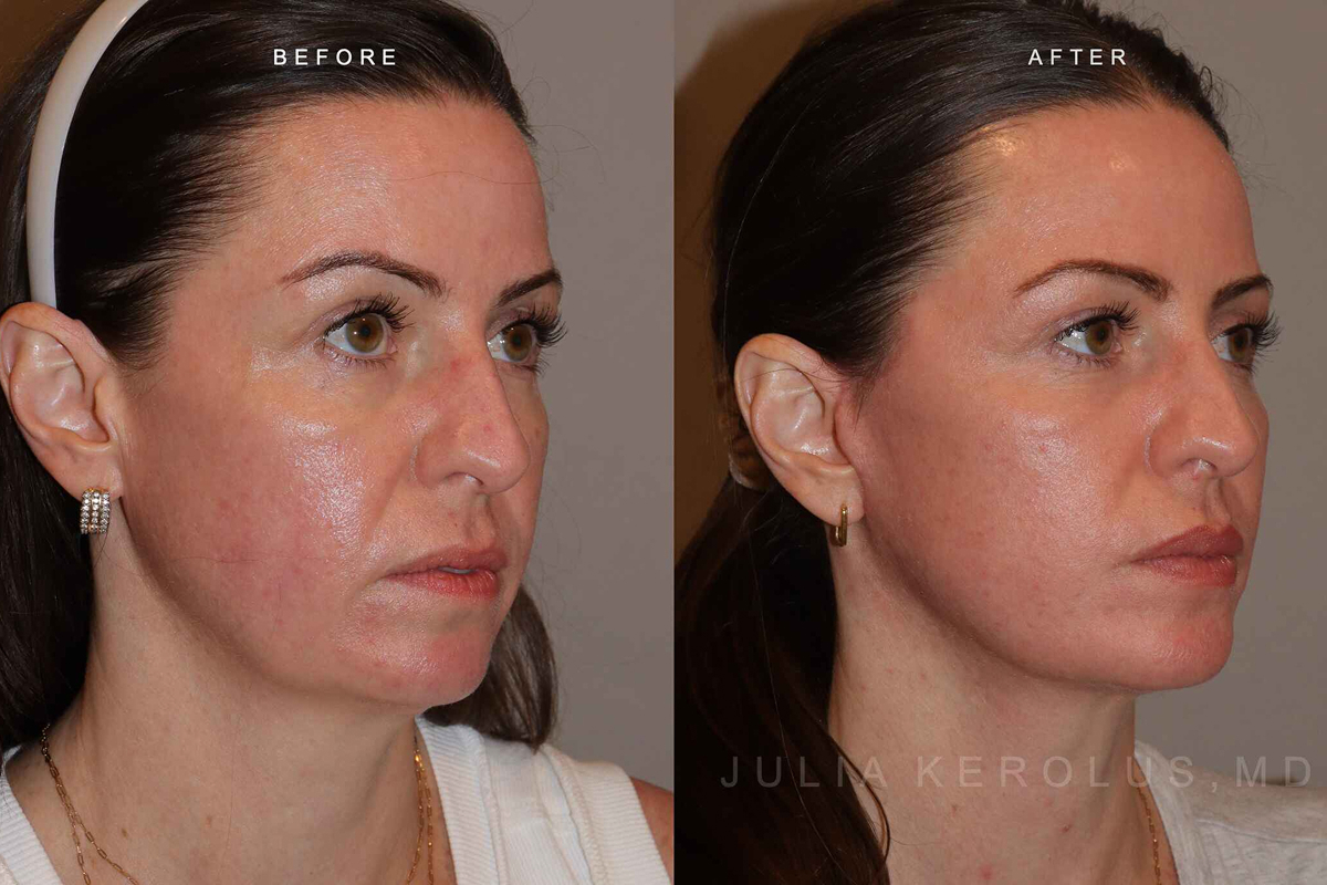 Facelift Before & After Image