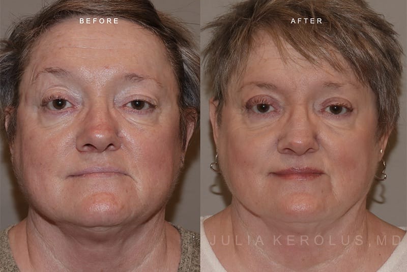 Reanimation Surgery Before & After Image