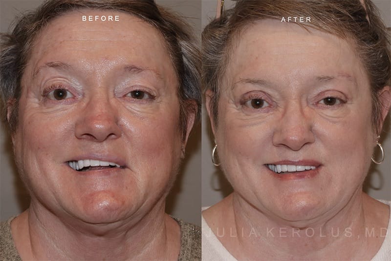 Reanimation Surgery Before & After Image