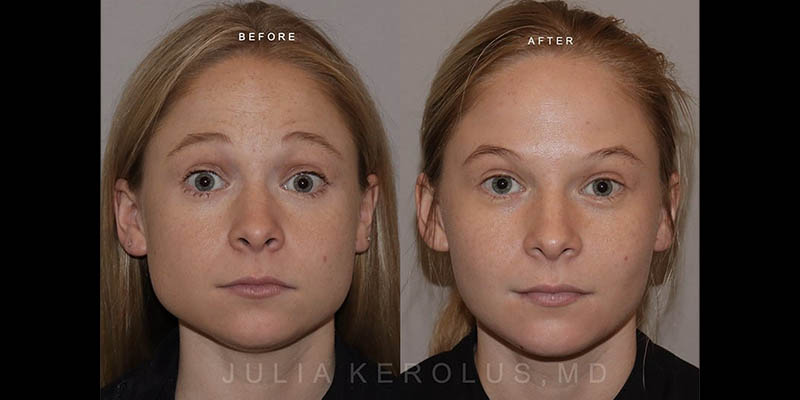 Neuromodulators (Botox/Dysport/Daxxify) Before & After Image