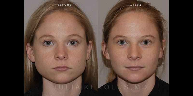 Neuromodulators (Botox/Dysport/Daxxify) Before & After Image