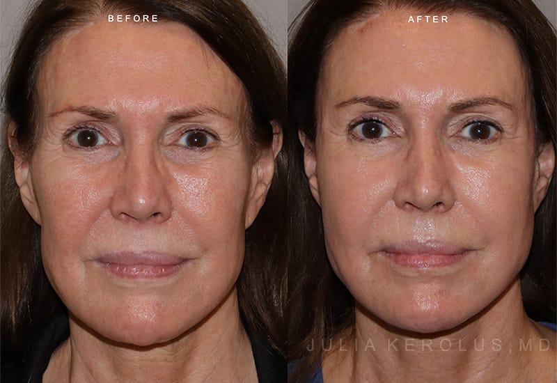 Sculptra Before & After Image